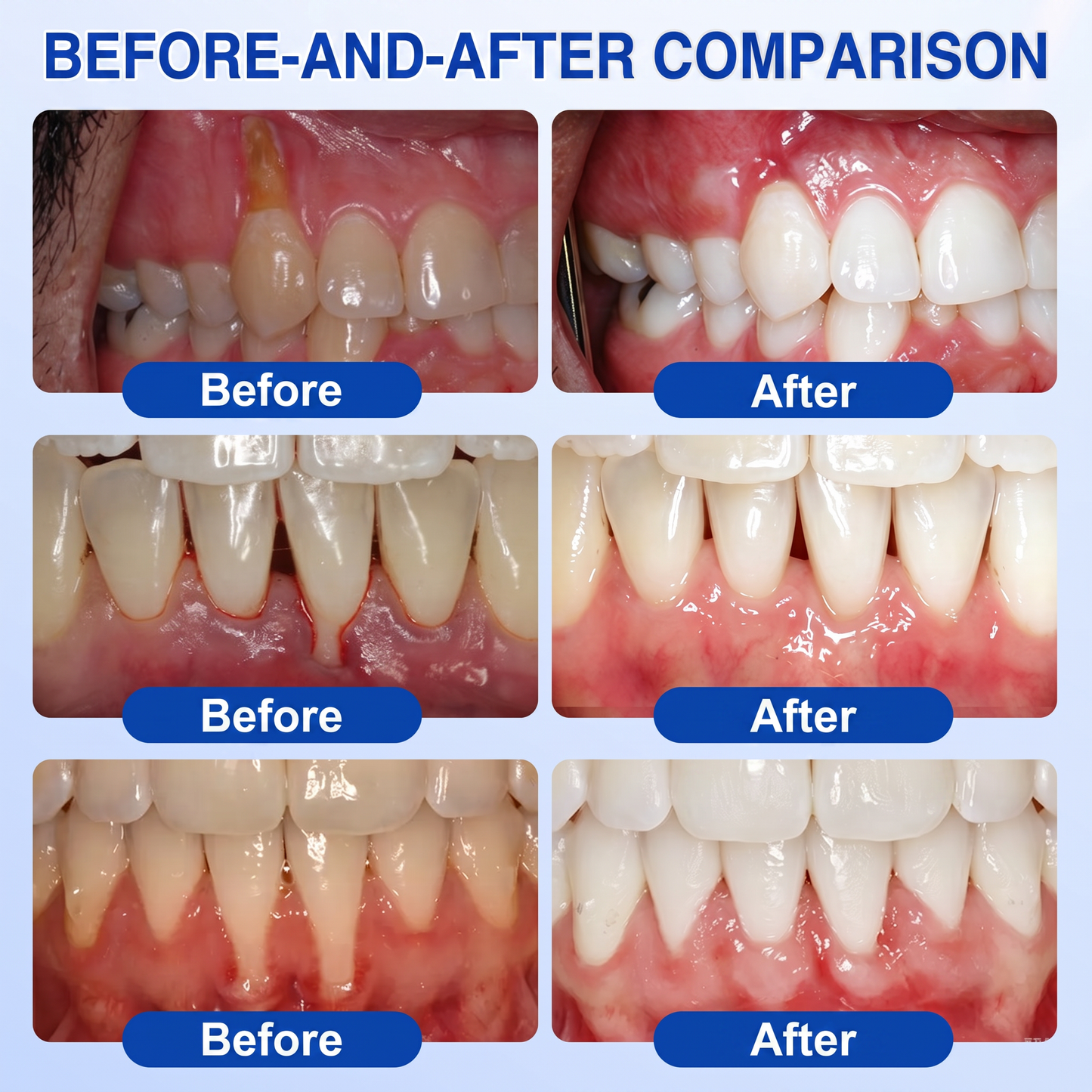 👨‍⚕️🦷✨Glimmerly® GumRevive periodontal repair gel
