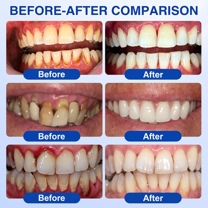👨‍⚕️🦷✨Glimmerly® GumRevive periodontal repair gel